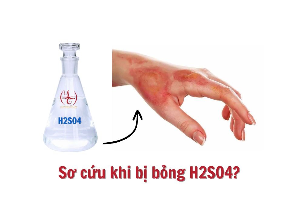 Quy trình sơ cứu khi bị bỏng axit H₂SO₄